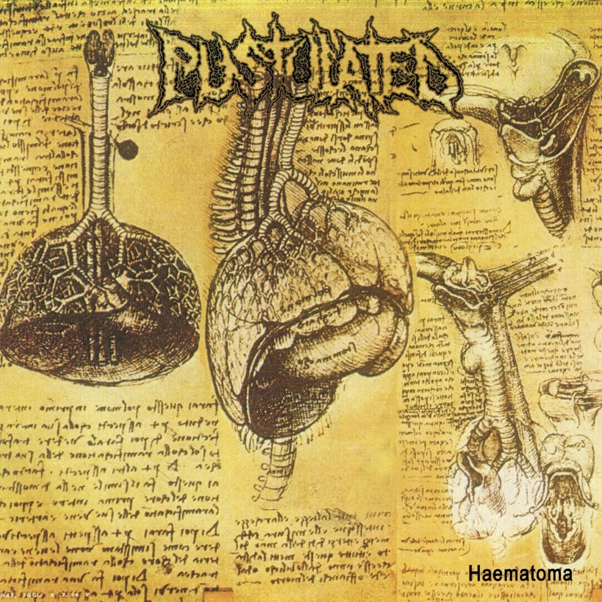 Haematoma