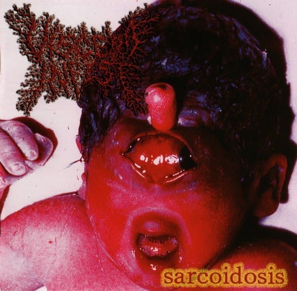 Sarcoidosis