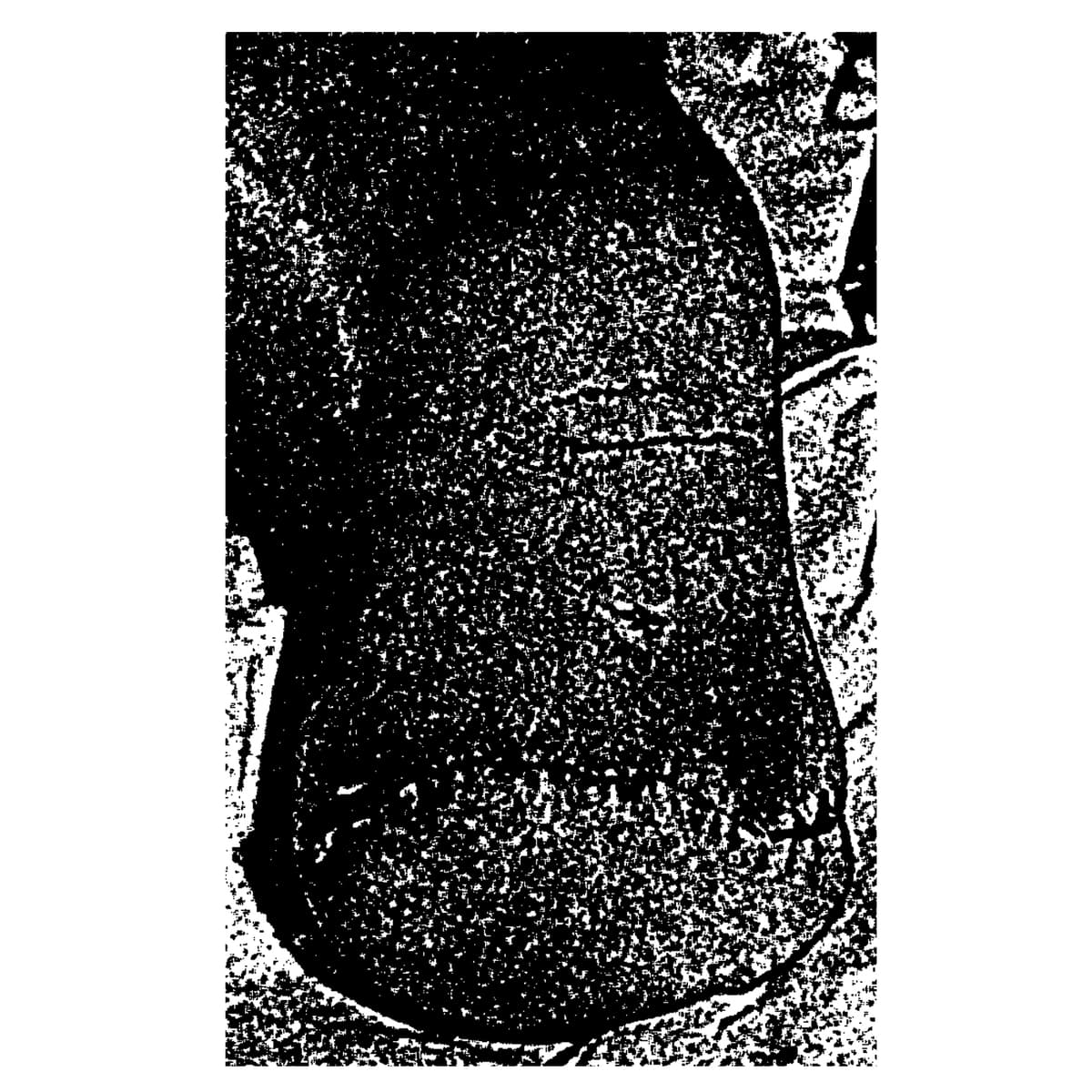 Traumatic Amputations III