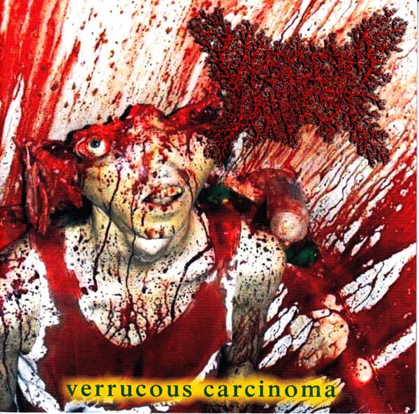 Verrucous Carcinoma